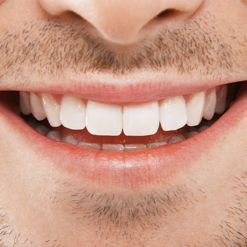 Teeth Bleaching